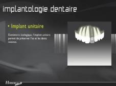 Implant unitaire Implant unitaire